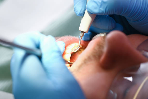 Best Emergency Root Canal Treatment in Drain, OR